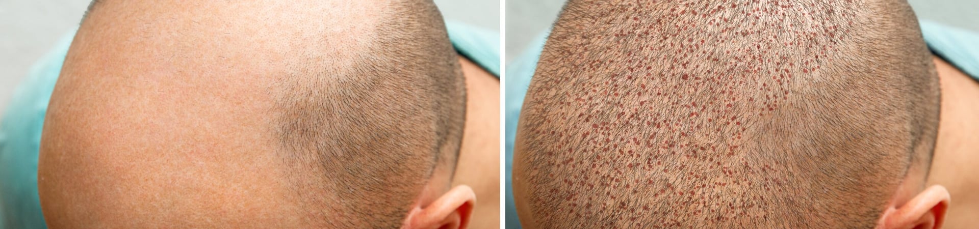 Hair Transplant